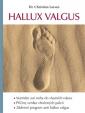 Hallux valgus